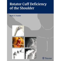 Rotator Cuff Deficiency of the Shoulder