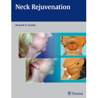 Neck Rejuvenation-Gentile