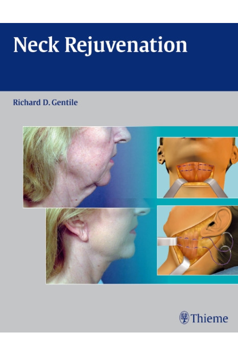 Neck Rejuvenation-Gentile