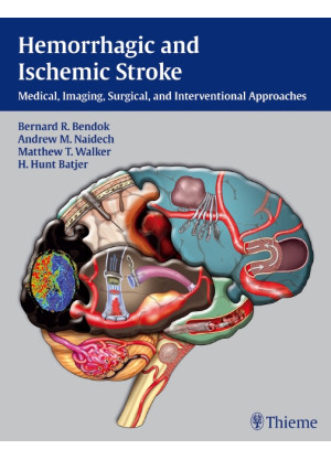 Hemorrhagic and Ischemic Stroke