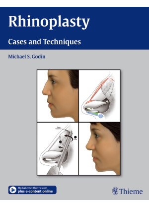 Rhinoplasty - Cases and Techniques