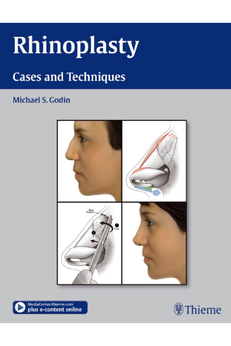 Rhinoplasty - Cases and Techniques