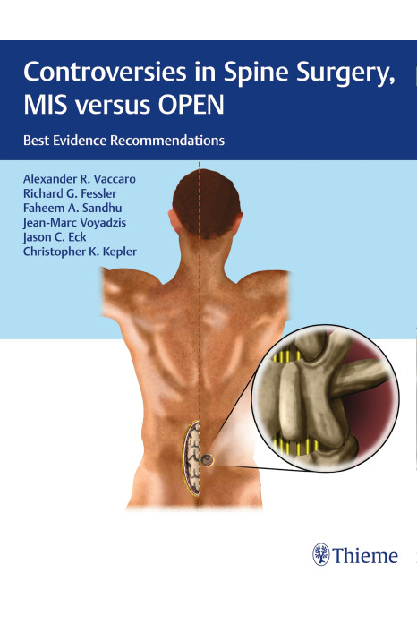 Controversies in Spine Surgery, MIS versus OPEN