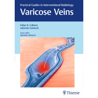 Varicose Veins