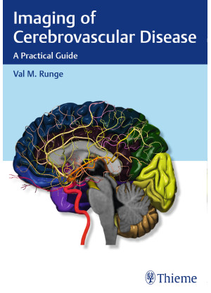 Imaging of Cerebrovascular Disease