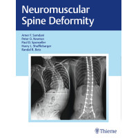 Neuromuscular Spine Deformity