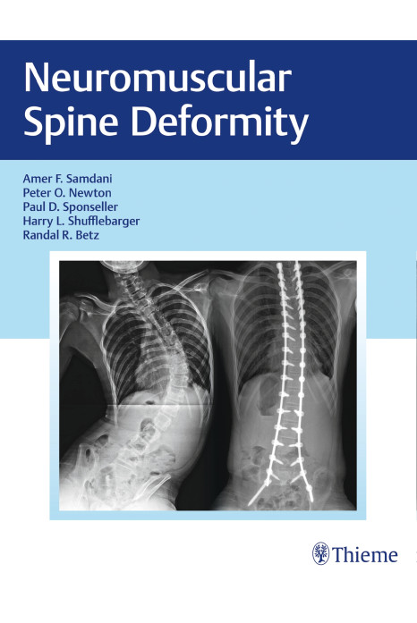 Neuromuscular Spine Deformity