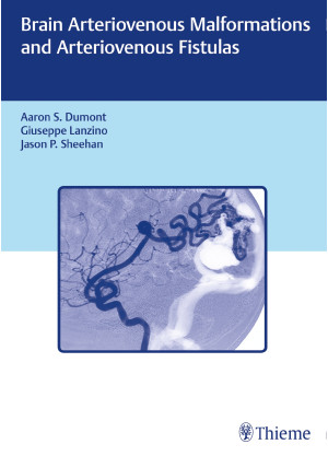 Brain Arteriovenous Malformations and Arteriovenous Fistulas