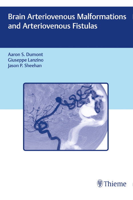 Brain Arteriovenous Malformations and Arteriovenous Fistulas