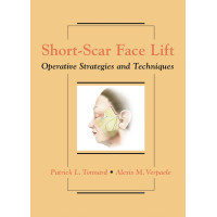 Short-Scar Face Lift