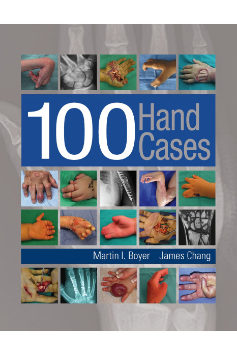 100 Hand Cases