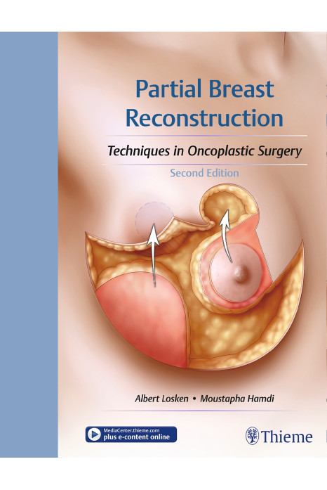 Partial Breast Reconstruction