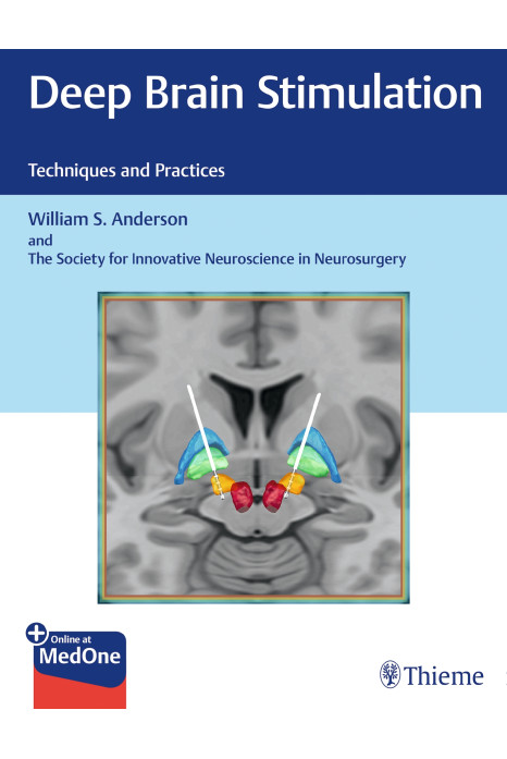 Deep Brain Stimulation