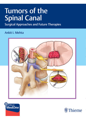 Tumors of the Spinal Canal