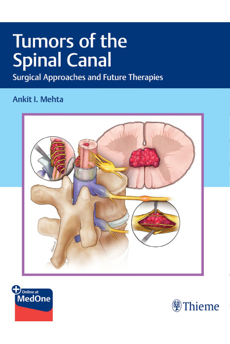 Tumors of the Spinal Canal