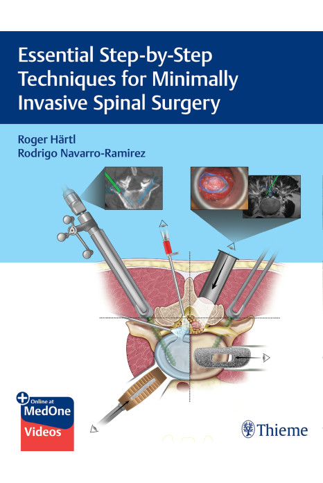 Essential Step-by-Step Techniques for Minimally Invasive Spinal Surgery