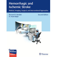 Hemorrhagic and Ischemic Stroke