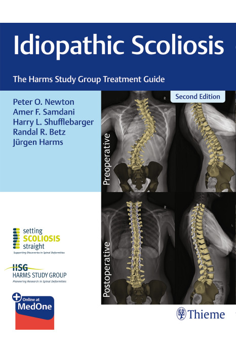 Idiopathic Scoliosis