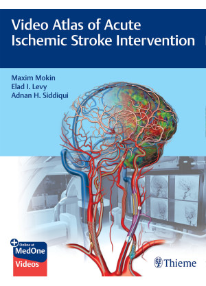 Video Atlas of Acute Ischemic Stroke Intervention