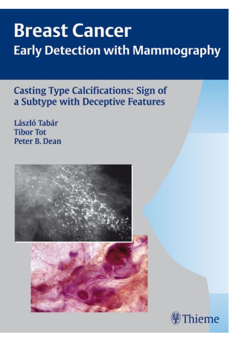 Casting-Type Calcifications