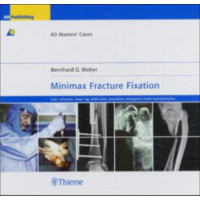 Minimax Fracture Fixation