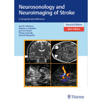 Neurosonology and Neuroimaging of Stroke