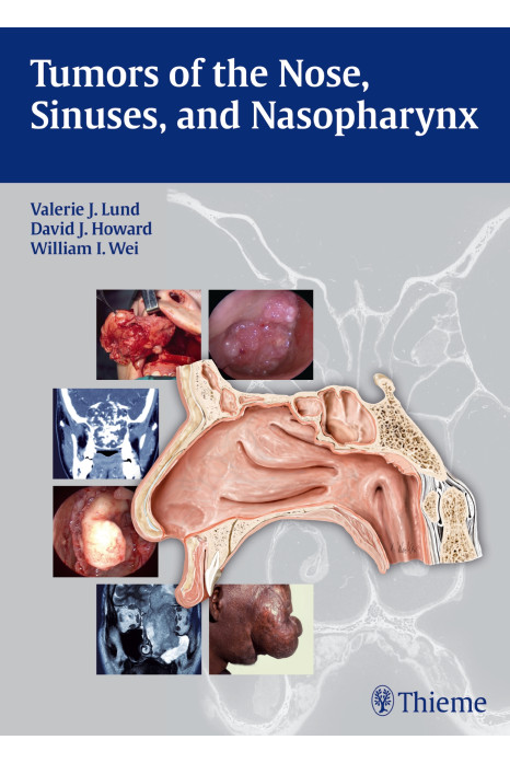 Tumors of the Nose, Sinuses and Nasopharynx