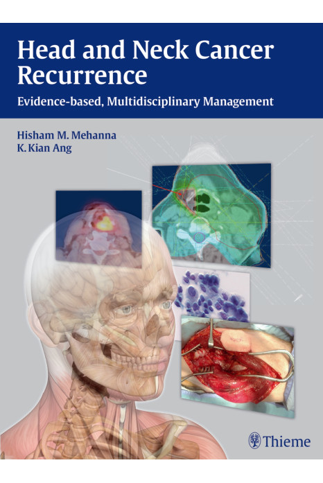 Head and Neck Cancer Recurrence