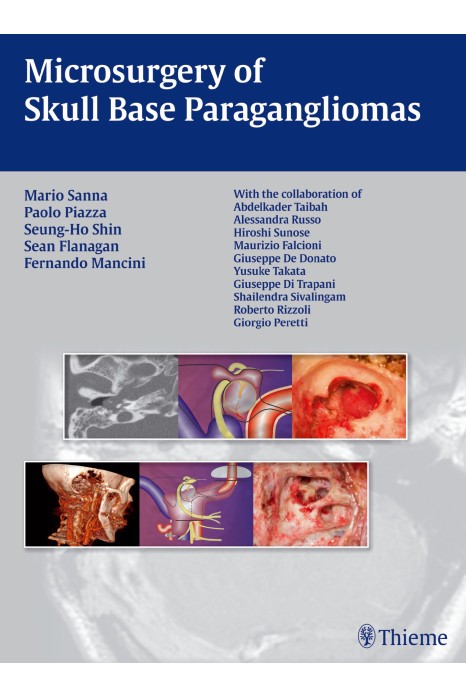 Microsurgery of Skull Base Paragangliomas