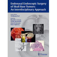 Endonasal Endoscopic Surgery of Skull Base Tumors