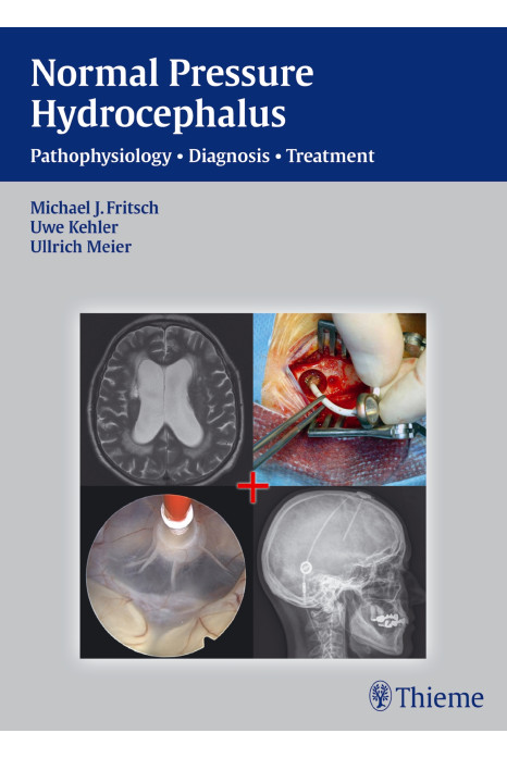 NPH - Normal Pressure Hydrocephalus