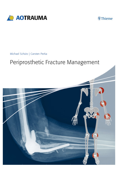 Periprosthetic Fracture Management