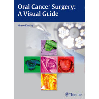 Oral Cancer Surgery