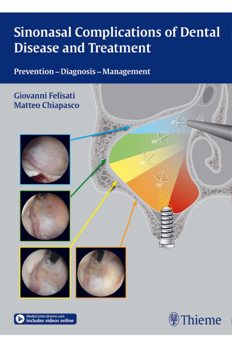 Sinonasal Complications of Dental Disease and Treatment