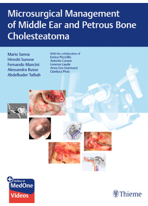 Microsurgical Management of Middle Ear and Petrous Bone Cholesteatoma