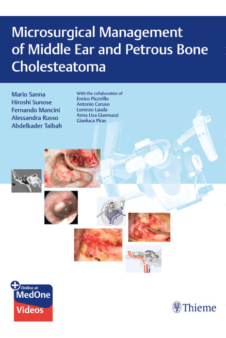 Microsurgical Management of Middle Ear and Petrous Bone Cholesteatoma