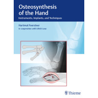 Osteosynthesis of the Hand