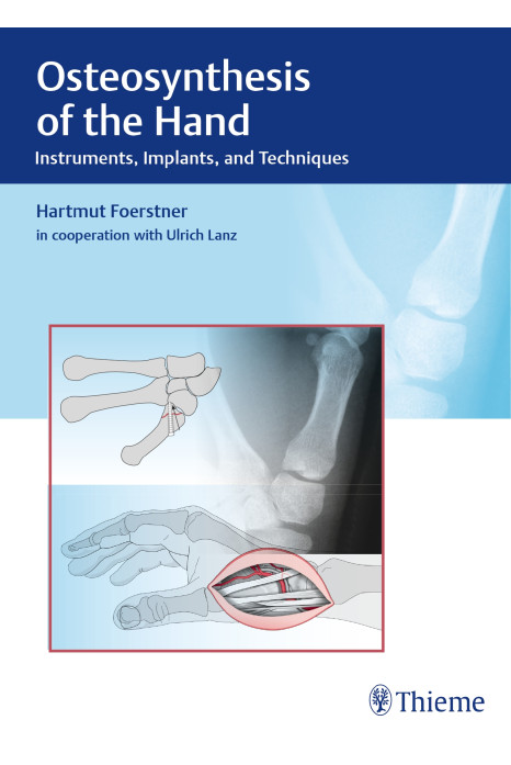 Osteosynthesis of the Hand