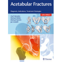 Acetabular Fractures