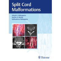 Split Cord Malformations