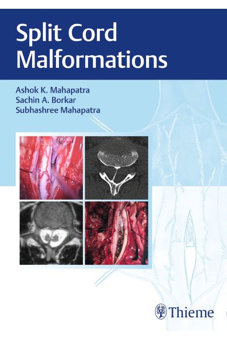 Split Cord Malformations