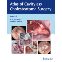 Atlas of Cavityless Cholesteatoma Surgery, Vol 1