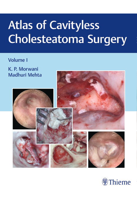 Atlas of Cavityless Cholesteatoma Surgery, Vol 1