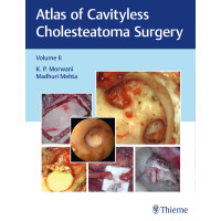 Atlas of Cavityless Cholesteatoma Surgery, Vol 2