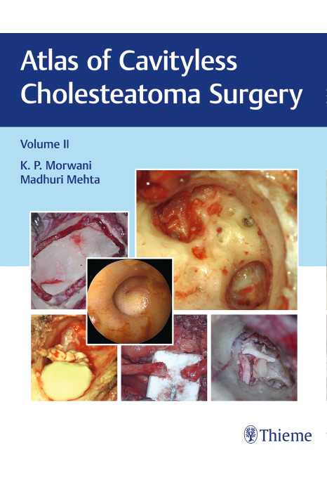 Atlas of Cavityless Cholesteatoma Surgery, Vol 2