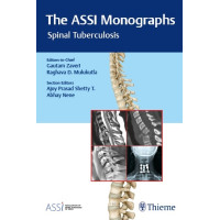 The ASSI Monographs—Spinal Tuberculosis