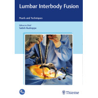 Lumbar Interbody Fusion