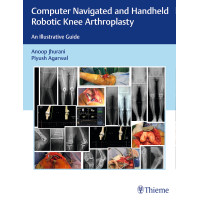 Computer Navigated and Handheld Robotic Knee Arthroplasty