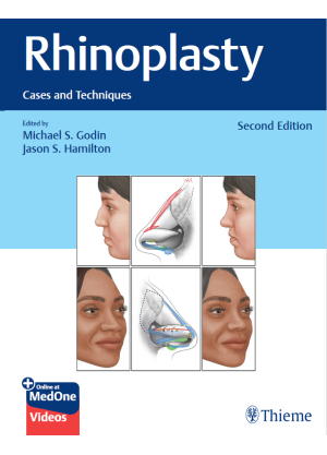 Rhinoplasty