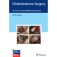 Cholesteatoma Surgery
